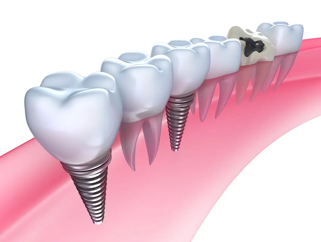Dental implants Bellevue WA