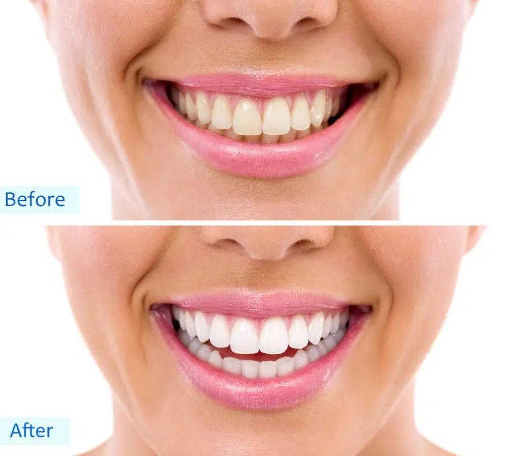 Teeth whitening Redmond Dentist 