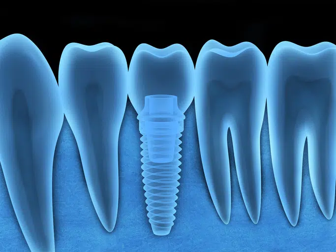 Dental Implant Options in Redmond