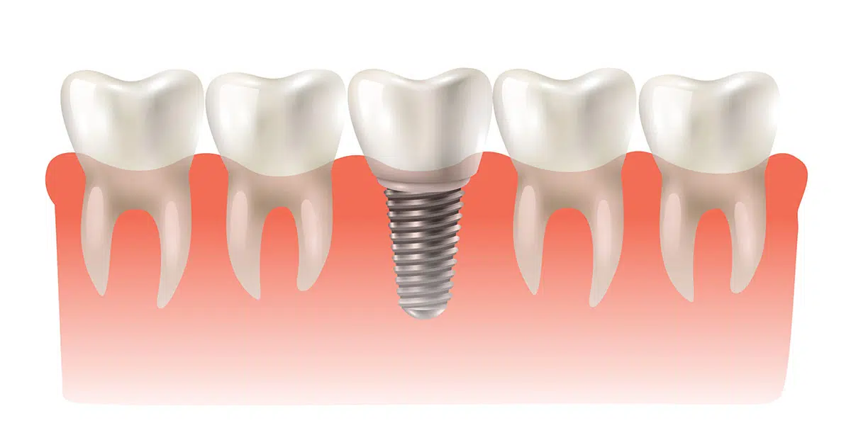 Dental Implants in Redmond