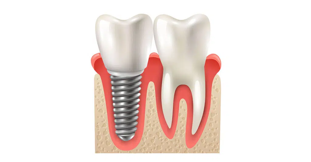 Dental Implants in Redmond