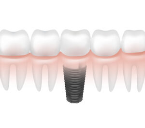 dental implants specialist Redmond WA