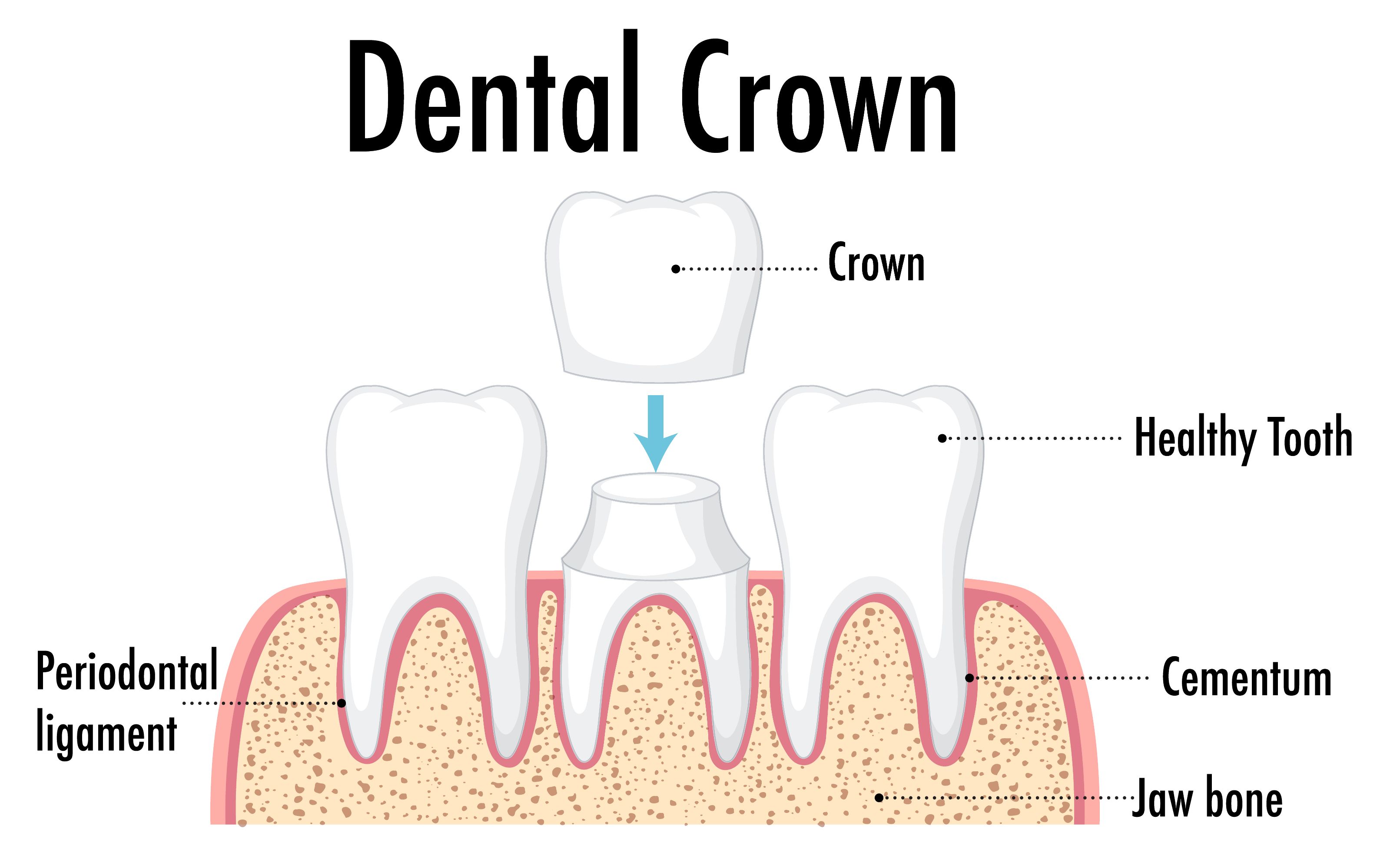 dental crowns and bridges