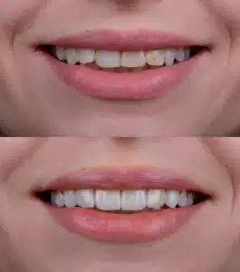 cosmetic dentistry Redmond WA