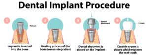 How Much Do Dental Implants Cost in Redmond? What to Expect